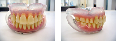 透明レジン床義歯