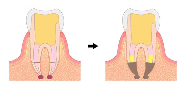 精密根管治療と歯根端切除術