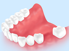インプラントは周りの歯に優しい治療です