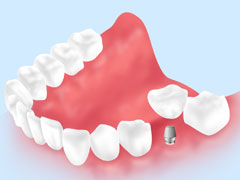 インプラントは周りの歯に優しい治療です