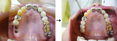 上の顎の奥歯2本治療