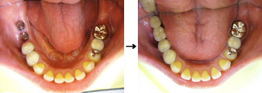 上の顎の奥歯2本治療