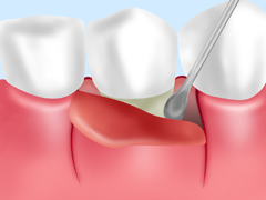 歯周ポケット掻爬(そうは)術